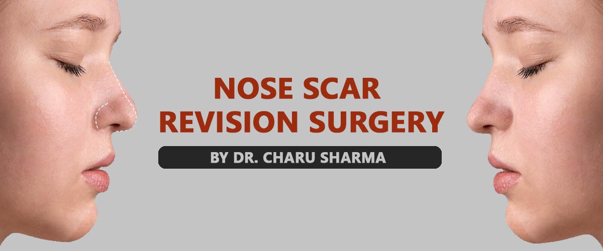 nose-scare-revision-surgery-delhi