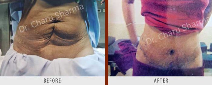 liposuction-surgery-delhi-3