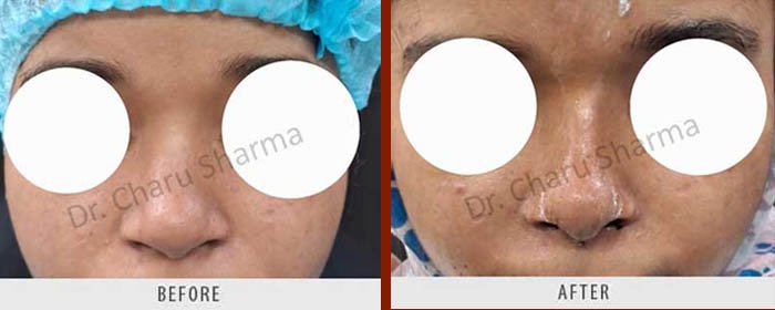 nose-scare-revision-surgery-delhi